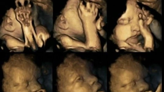 Il feto di una donna che fuma in gravidanza (Foto Durham University)