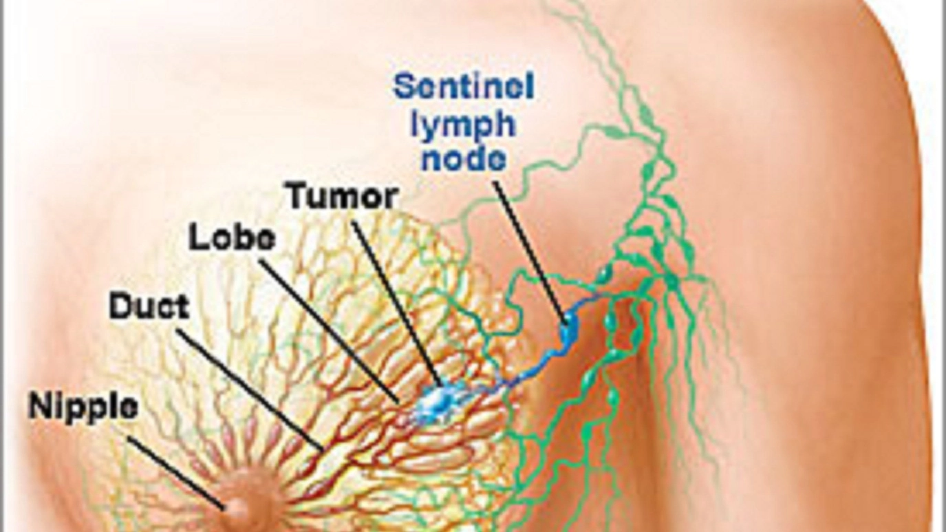 L'anatomia della mammella, la localizzazione di un nodulo (celeste) e il linfonodo sentinella