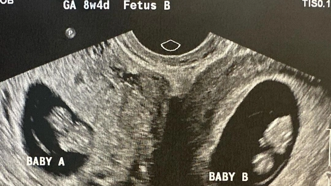 Kelsey Hatcher aspetta due gemelli da due uteri (Instagram)