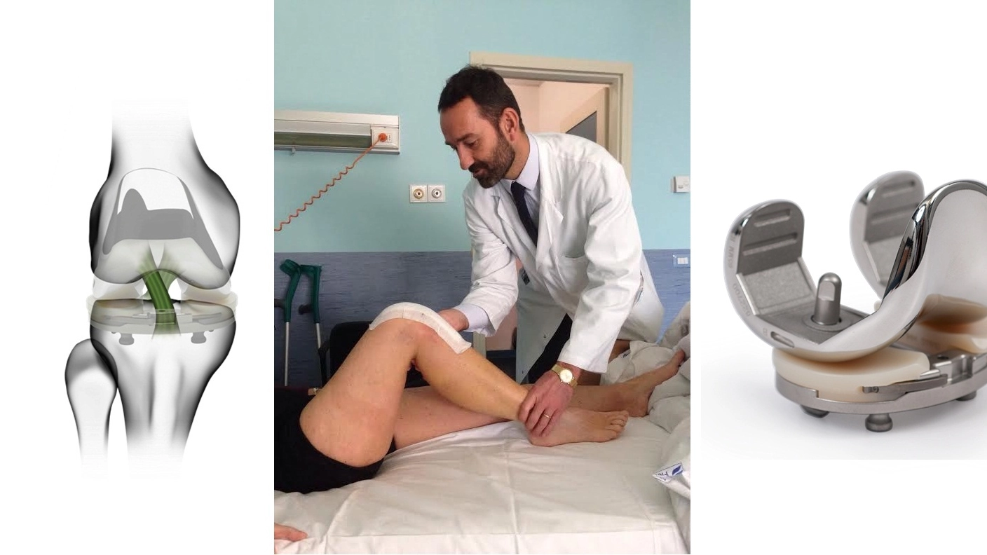 L'anatomia del ginocchio, le protesi innovative e la riabilitazione post intervento