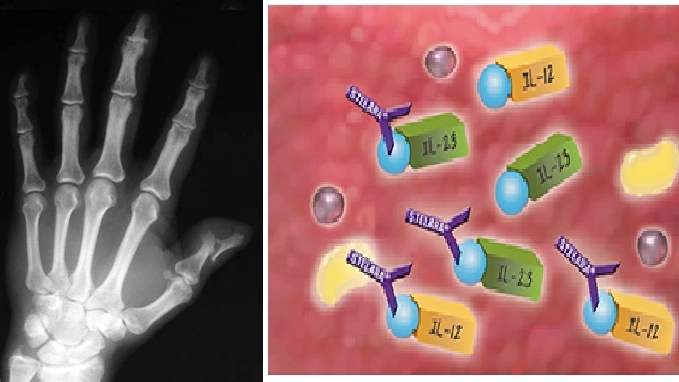 Gli effetti dell'artrite psoriasica, a destra il meccanismo del farmaco dal sito www.stelarainfo.com