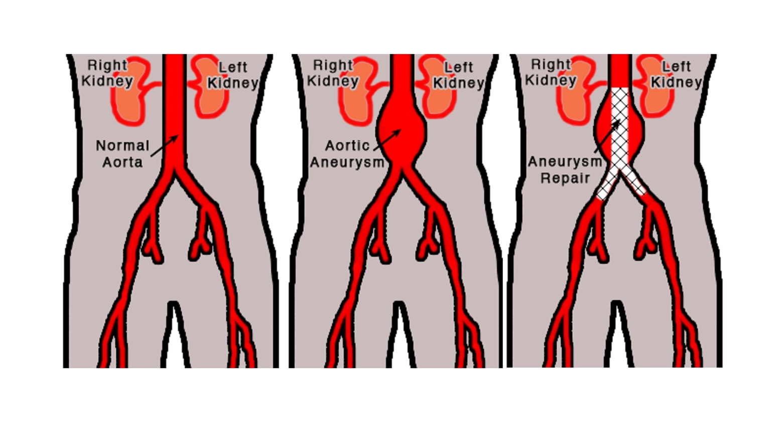 Aorta addominale, al centro l'aneurisma, a destra la riparazione del tronco arterioso