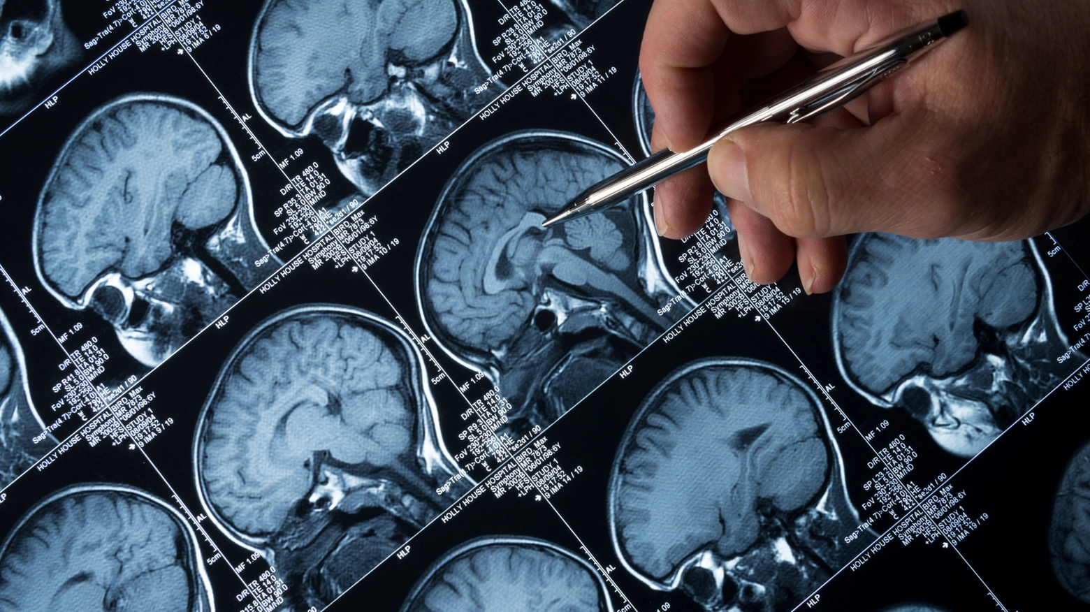 Diagnosi dell'Alzheimer, la svolta potrebbe essere vicina