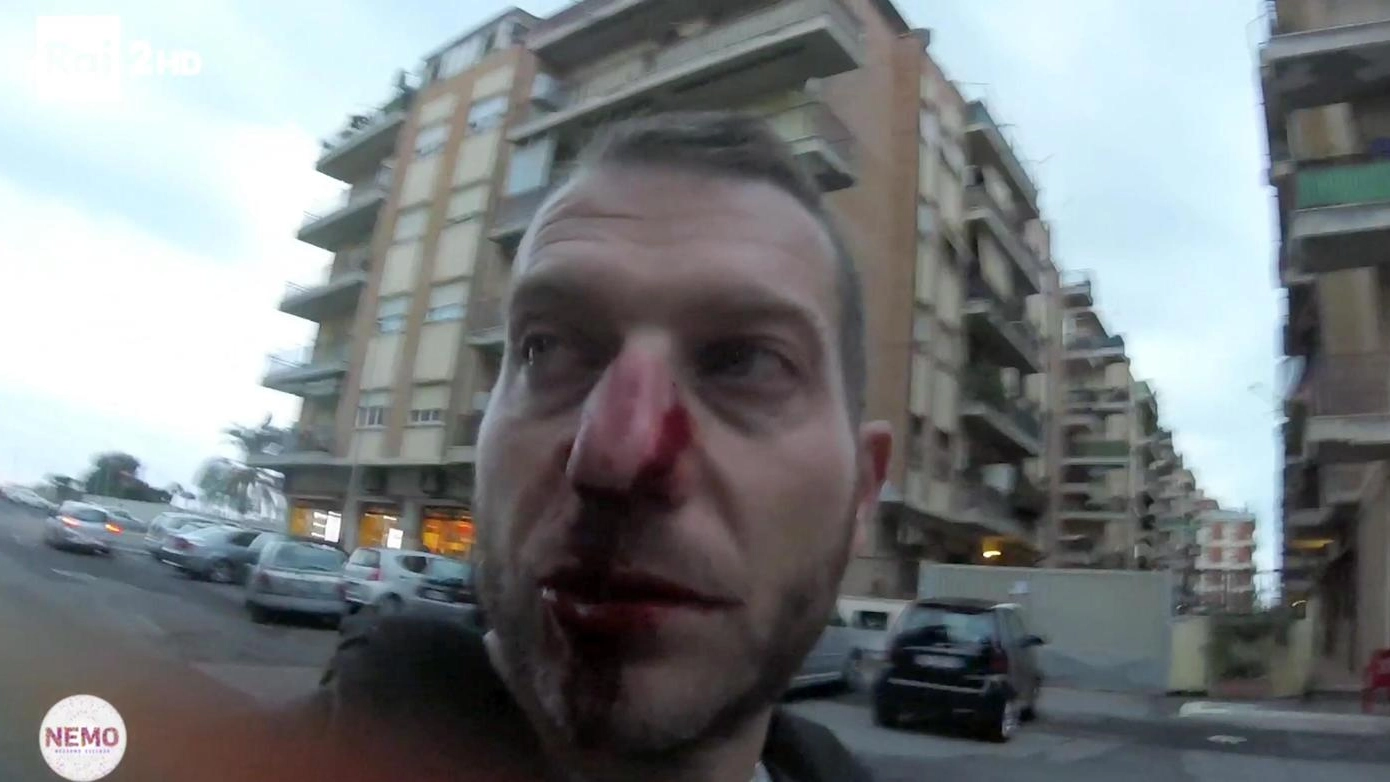 Il giornalista Daniele Piervincenzi con il naso rotto dopo l'aggressione (Ansa)