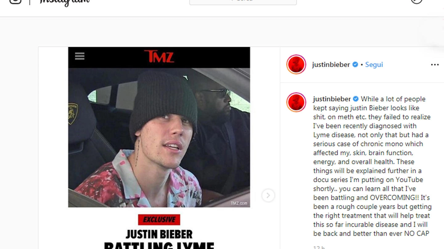 Justin Bieber rivela di essere affetto dalla Malattia di Lyme