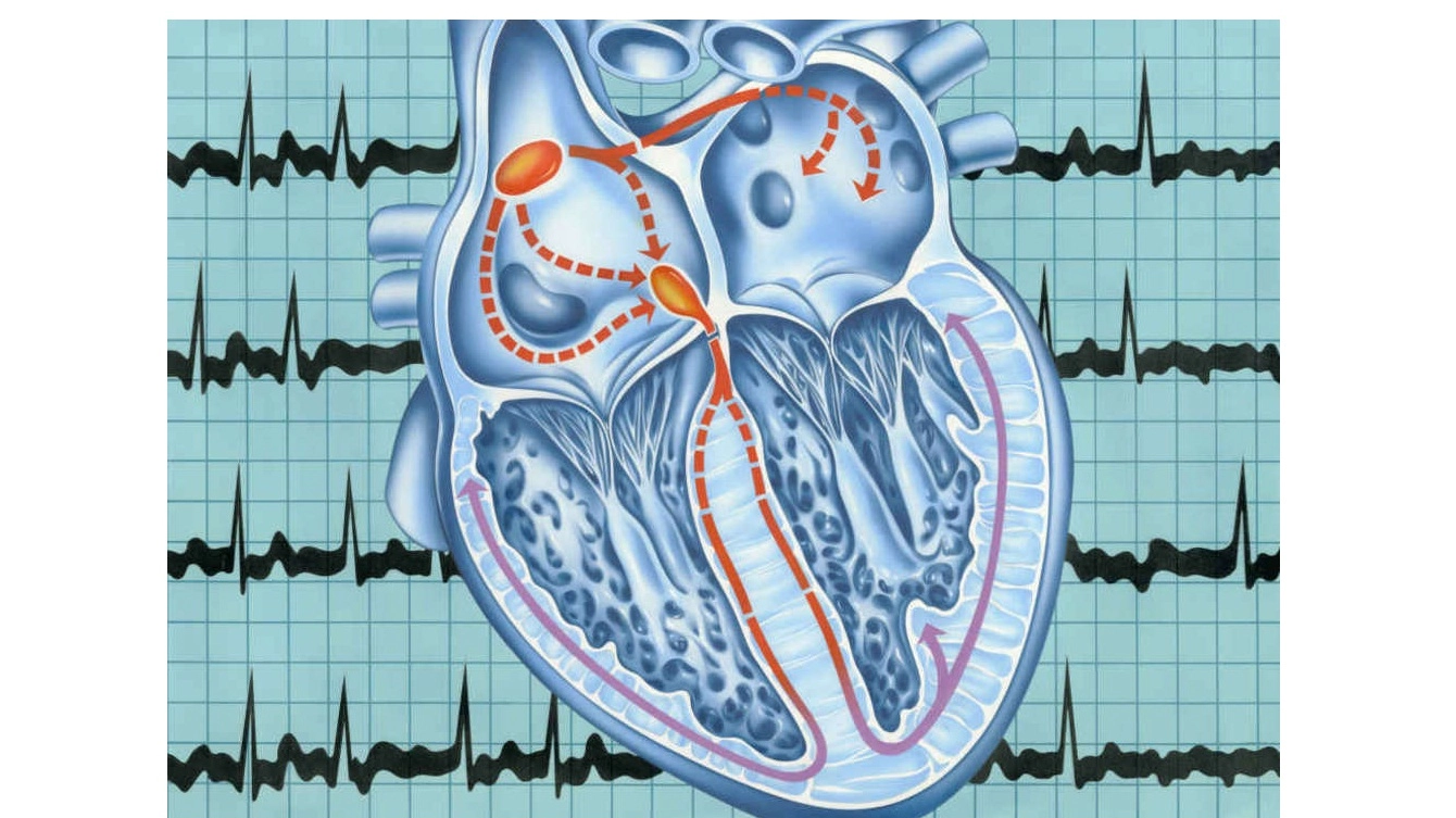 Un tracciato elettrocardiografico e gli impulsi che determinano l'extrasistole