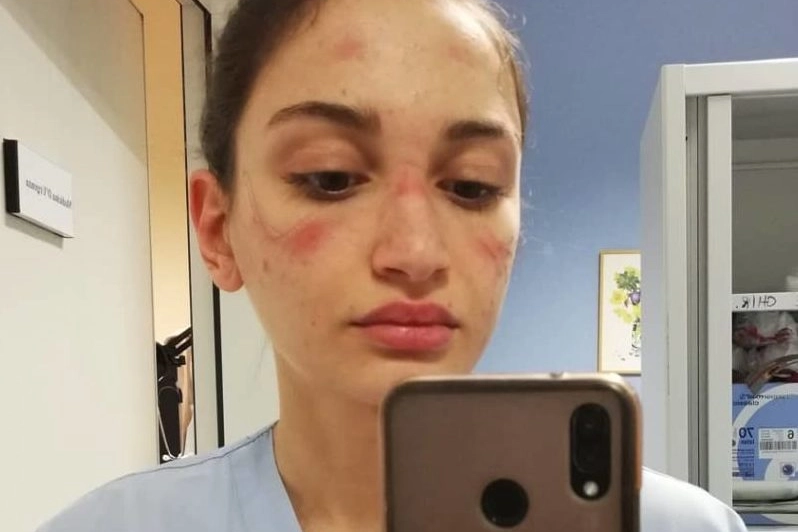 Durante la prima ondata di Covid l'infermiera Alessia Bonari mostrava i segni della mascherina sul volto