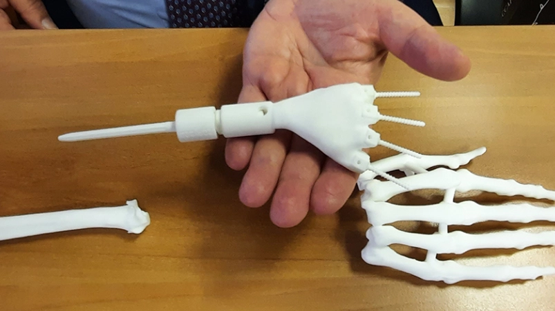 Il polso tridimensionale fatto stampare su misura dai medici che ha salvato una paziente da un'amputazione