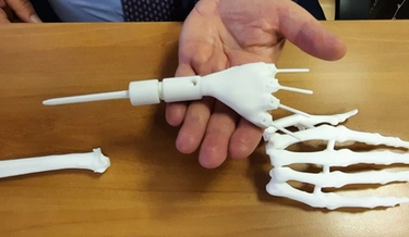 Polso stampato in 3D evita amputazione: chirurghi del Gemelli pionieri