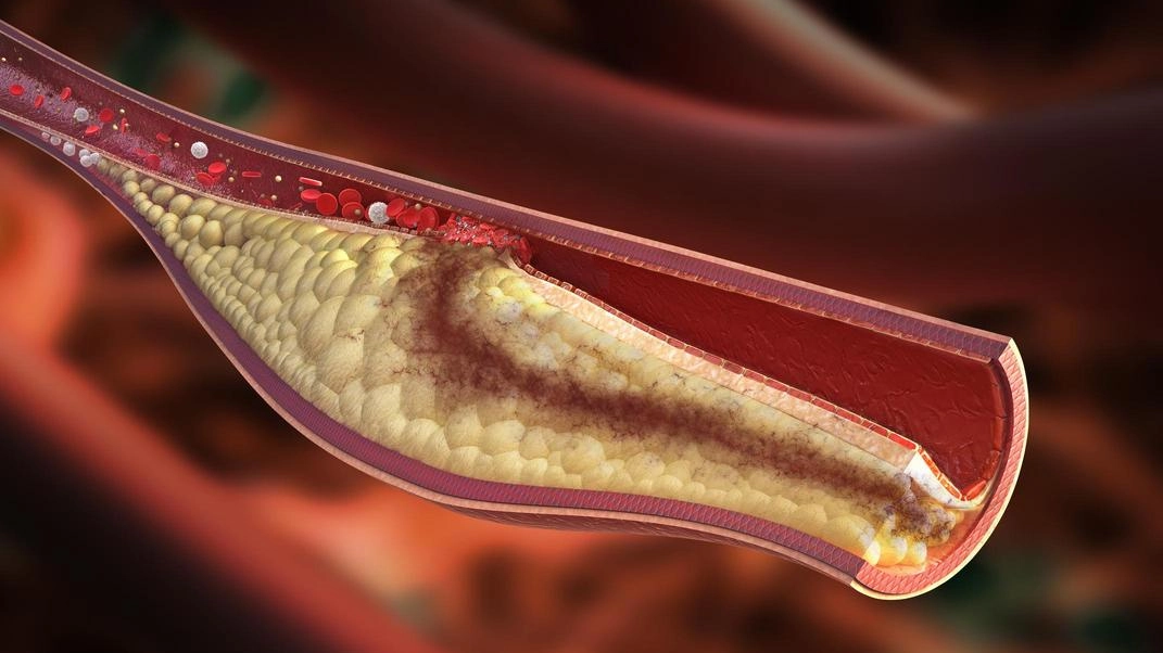 I nottambuli  rischiano  l’aterosclerosi  delle arterie