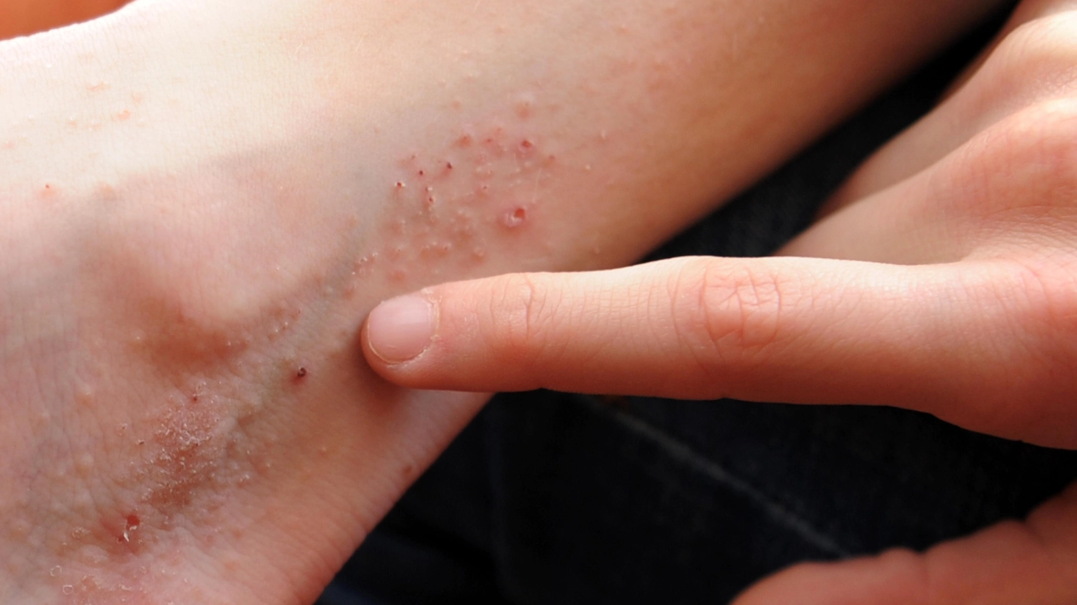 Dermatite acuta sulla caviglia di una ragazza allergica (Ansa)