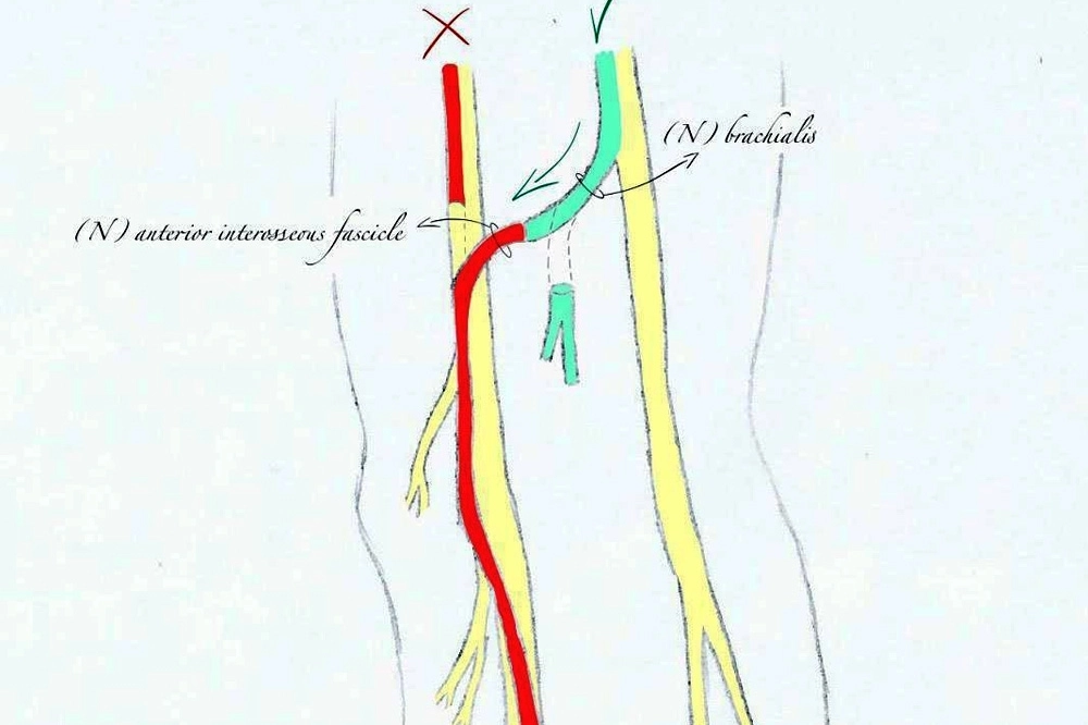 Lo schema dell'intervento di bypass dei nervi lesionati