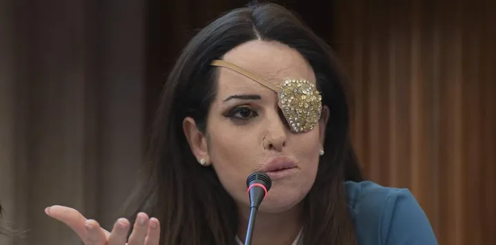 Gessica Notaro, 31 anni, showgirl riminese sfregiata con l’acido dall’ex nel 2017