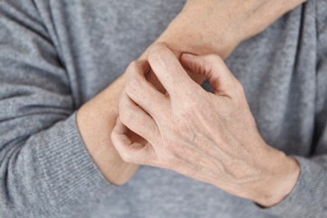artrite psoriasica