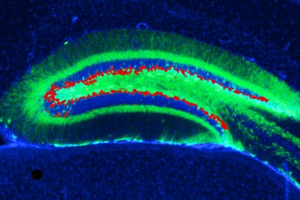 ippocampo brain glioblastoma tumore al cervello